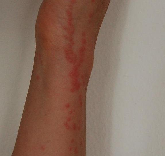 This photograph is a closeup of a person's left arm. The red bumps are the bed bug bites (courtesy of Wikicommons user, Raketenolli)